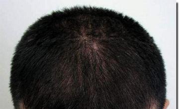 Hair restoration procedure results