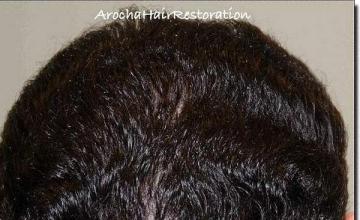 Hair restoration procedure results