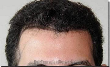 Hair restoration procedure results