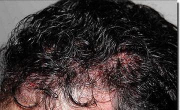 Hair restoration procedure results