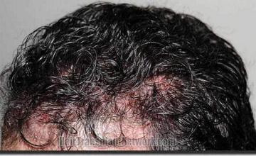 Hair restoration procedure results