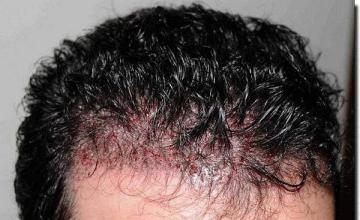 Hair restoration procedure results