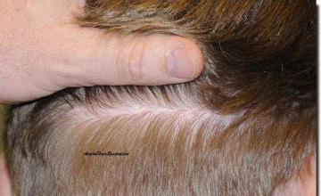 Hair restoration procedure results