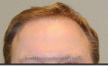 Hair restoration procedure results