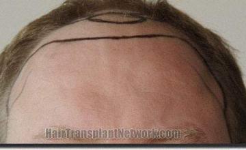 Hair restoration procedure results