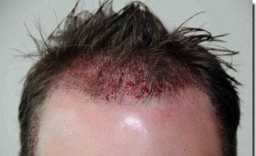 Hair restoration procedure results