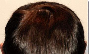 Hair restoration procedure results