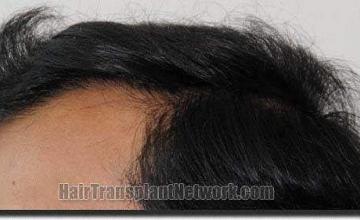 Hair restoration procedure results