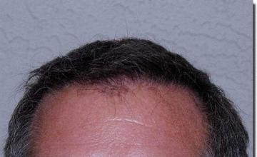 Hair restoration procedure results