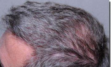 Hair restoration procedure results