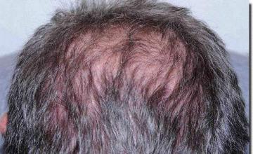 Hair restoration procedure results