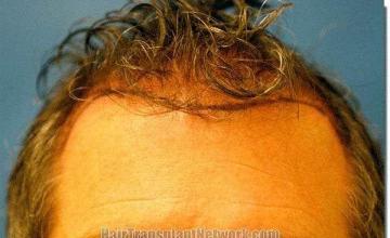 Hair restoration procedure results