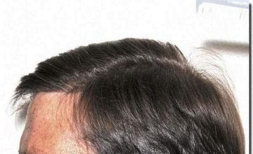 Hair restoration procedure results