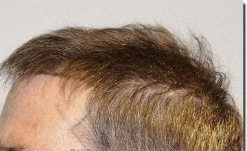 Hair restoration procedure results