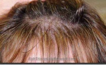 Hair restoration procedure results