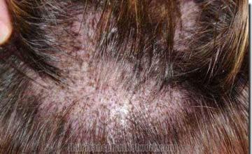 Hair restoration procedure results