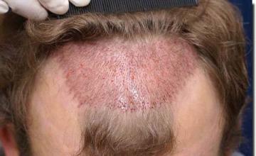 Hair restoration procedure results