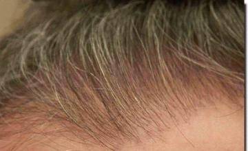 Hair restoration procedure results