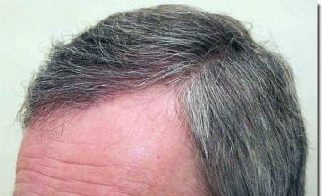 Hair restoration procedure results