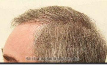 Hair restoration procedure results