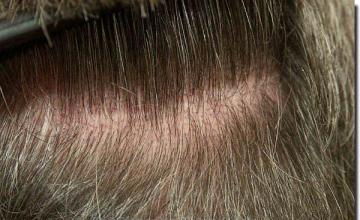 Hair restoration procedure results