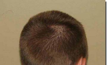 Hair restoration procedure results