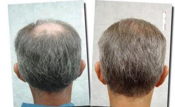 Hair restoration procedure results