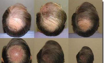 Hair restoration procedure results