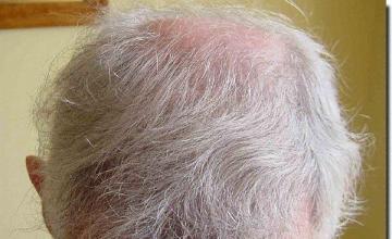 Hair restoration procedure results