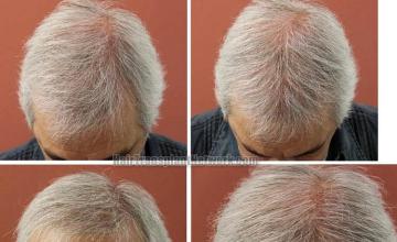 Hair restoration procedure before and after pictures