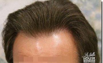 Hair restoration procedure results