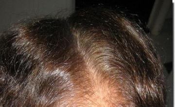 Hair restoration procedure results