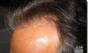 Hair restoration procedure results