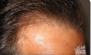 Hair restoration procedure results