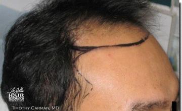 Hair restoration procedure results