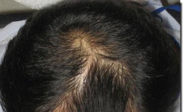 Hair restoration procedure results