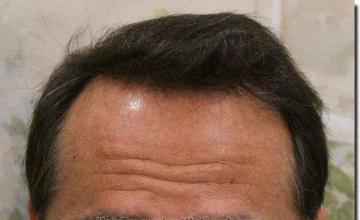 Hair restoration procedure results