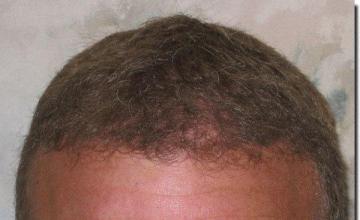 Hair restoration procedure results