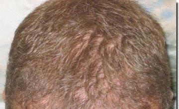 Hair restoration procedure results