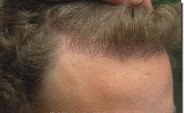 Hair restoration procedure results