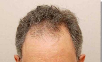 Hair restoration procedure results