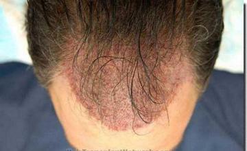 Hair restoration procedure results