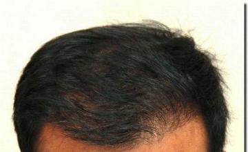 Hair restoration procedure results