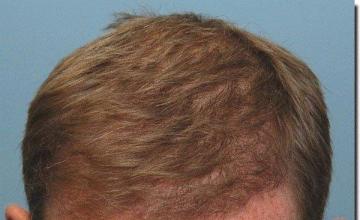 Hair restoration procedure results