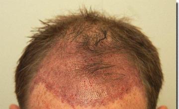 Hair restoration procedure results