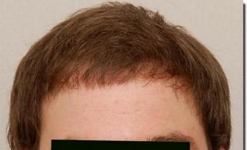 Hair restoration procedure results