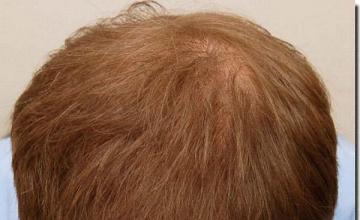 Hair restoration procedure results