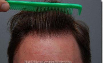 Hair restoration procedure results