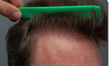 Hair restoration procedure results