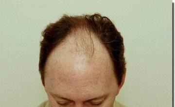 Hair restoration procedure results